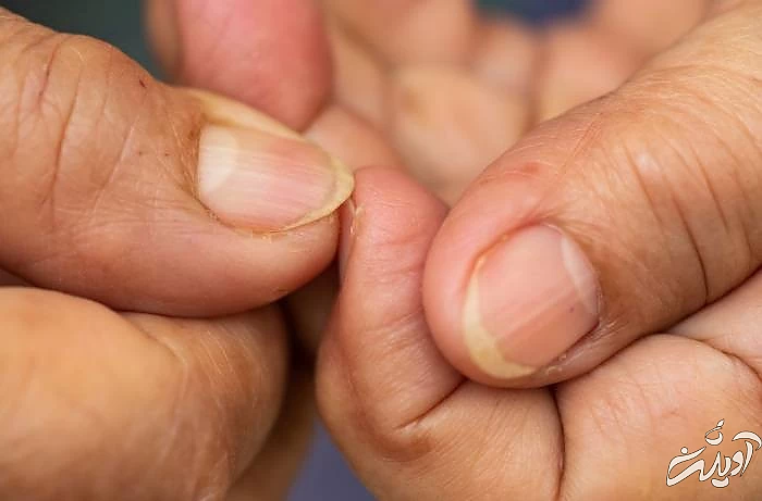 تاثیر دیابت روی ناخن ها ارتباط ناخن و دیابت